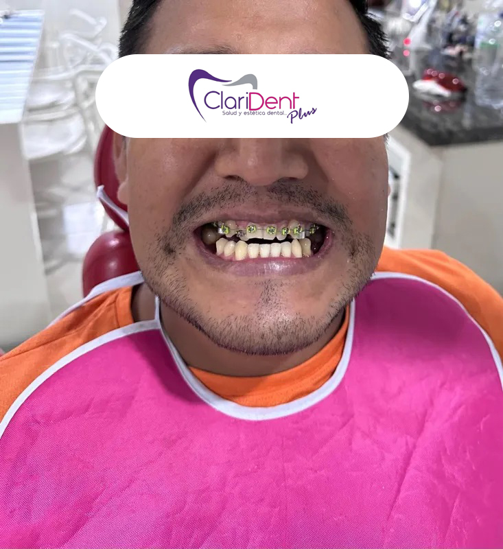 Brackets metálicos