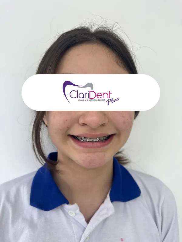 Brackets metálicos