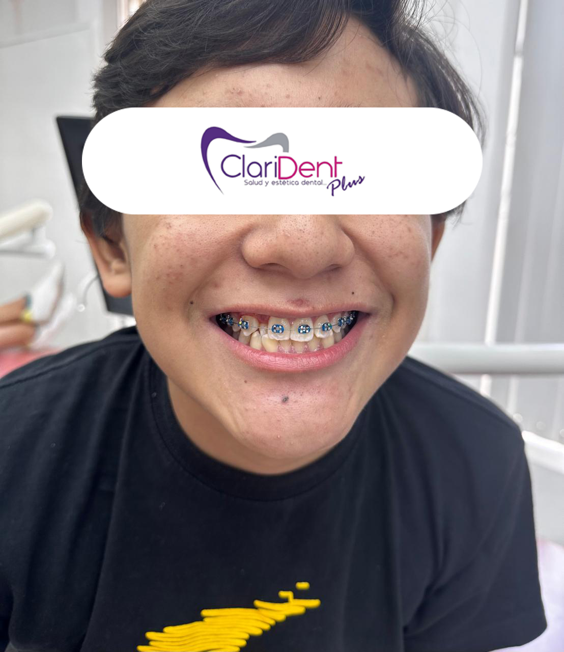 Brackets metálicos