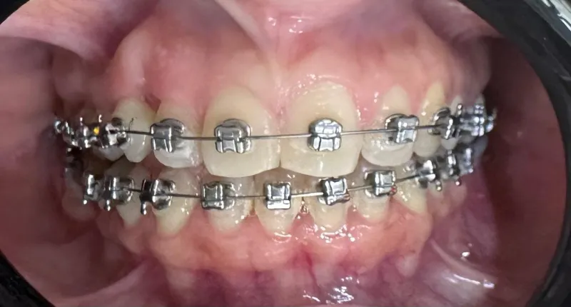 Brackets autoligado