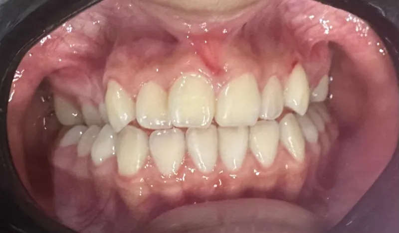 Brackets metalicos