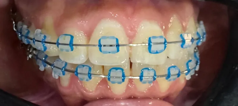Brackets metalicos