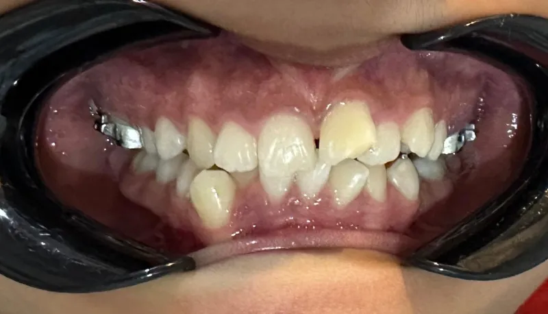 Brackets metalicos
