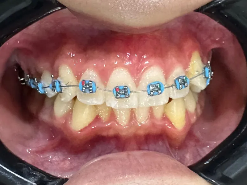 Brackets metalicos